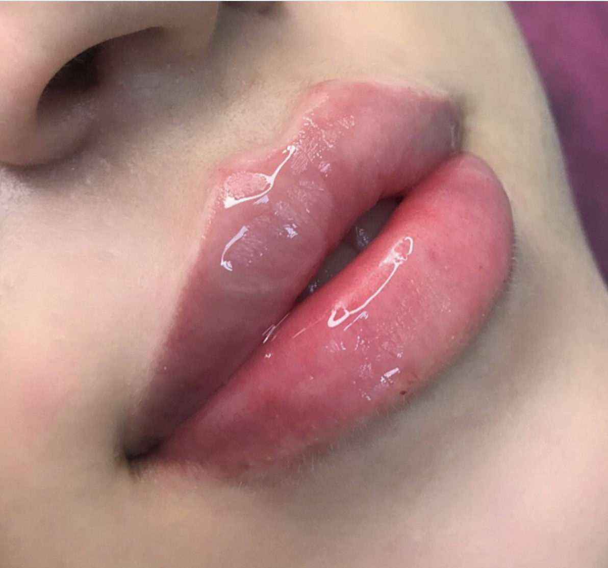 Lippenkontur und Kussmund als Beispiel für Lippenformung mit Hyaluron
