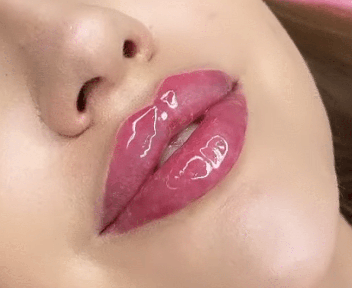 Lippen-aufspritzen-