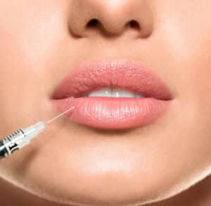 Lippenunterspritzung Zürich