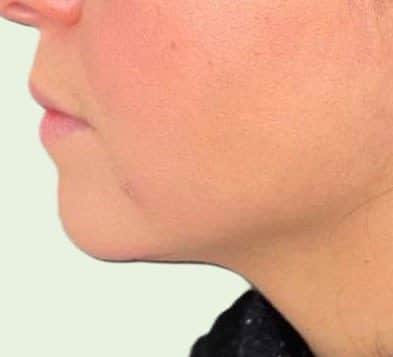 Doppelkinn Fett Weg- Spritze nachher