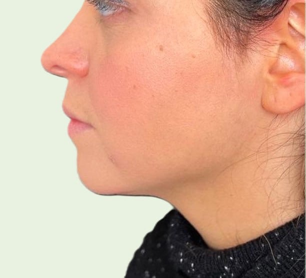 Doppelkinn Fett Weg- Spritze nachher