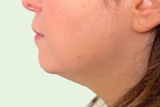 Doppelkinn Fett Weg- Spritze vorher