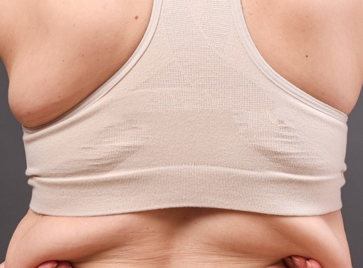 etails zur Fett Weg Spritze Rücken zur Entfernung Rückenfett