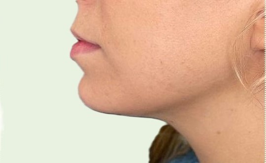 Doppelkinn Fett Weg Spritze Nachher