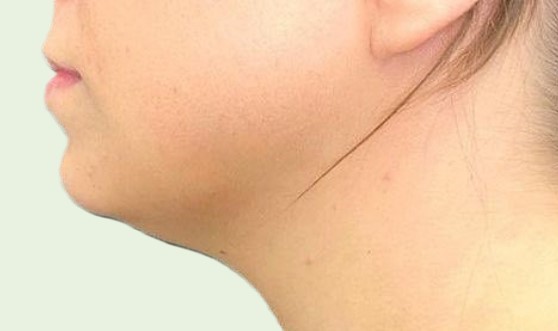 Doppelkinn Fett Weg Spritze Zürich vorher