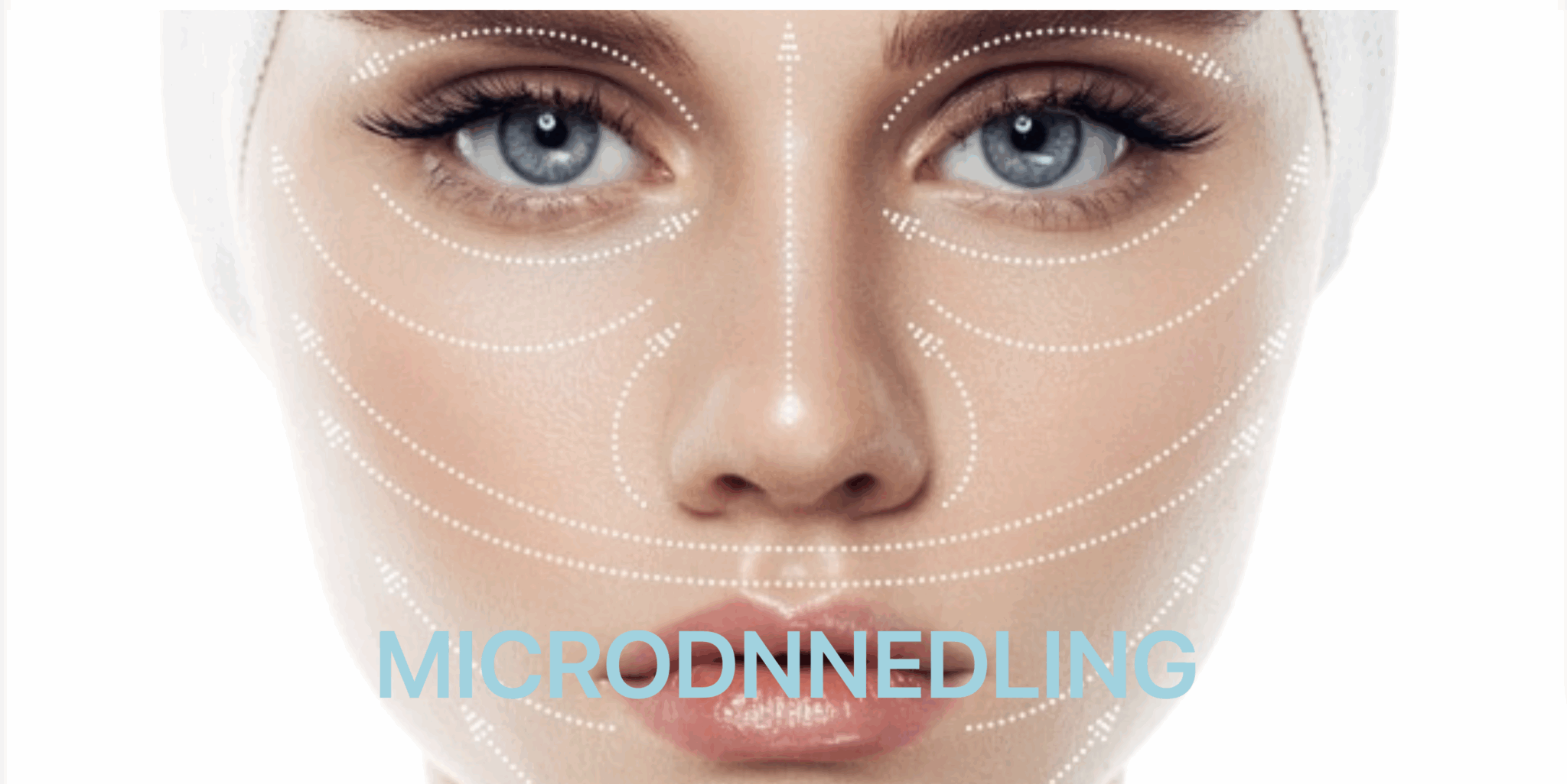 Microneedling Zürich