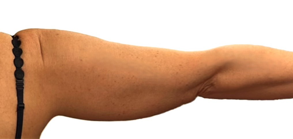 Fadenlifting Arme vorher Bild