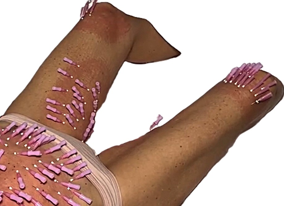 Fadenlifting Oberschenkelinnenseite Bild