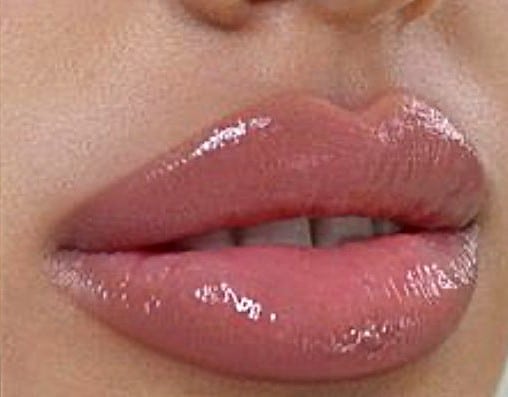 Lippenvergrösserung besondere Details zur Methode mit Fillern