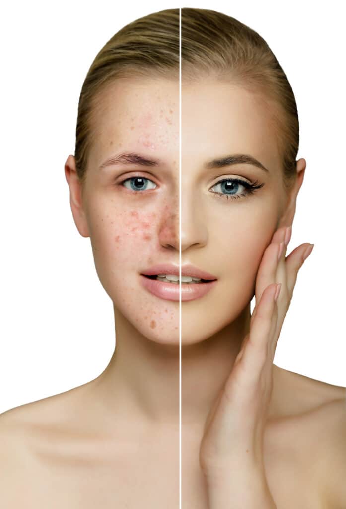 Detaillierte Infos zum Vampir Lifting gegen Akne und Aknenarben