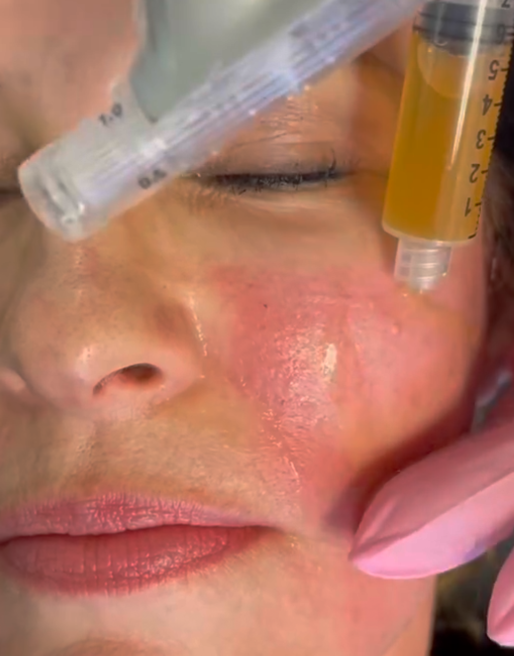 Auftragen des Plasma nach Mikroneedling