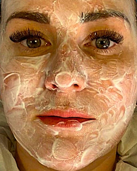 Vampir Lifting Auftragen der Betäubungscreme