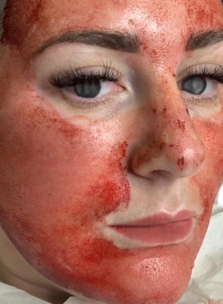 Vampire Facial nach dem Microneedling, Plasma