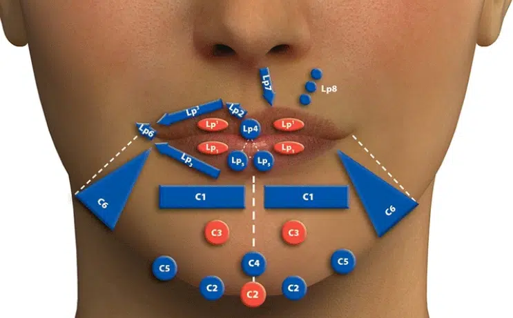 MD codes Lippen perfekte Lippenunterspritzung