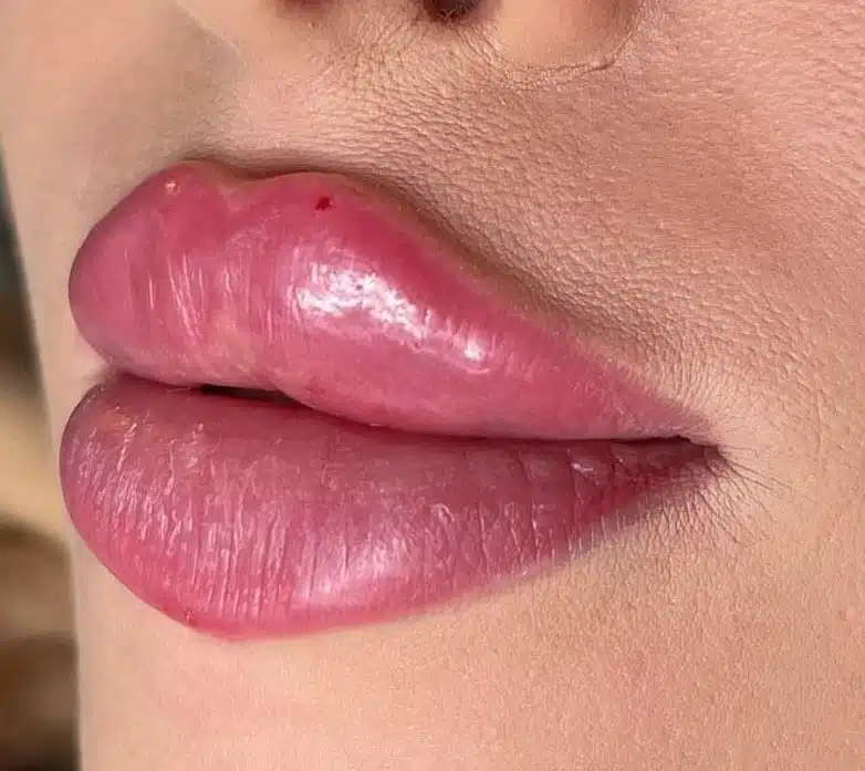 Lippenvergrösserung besondere Angaben